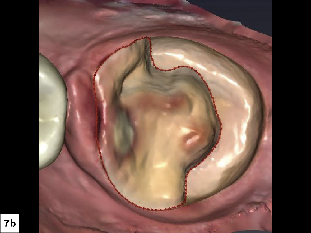 Figure 7b: Second intraoral scan