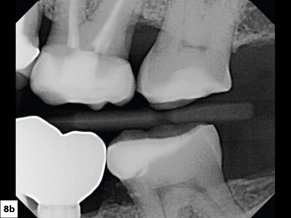 Figure 8b: X-ray of final result