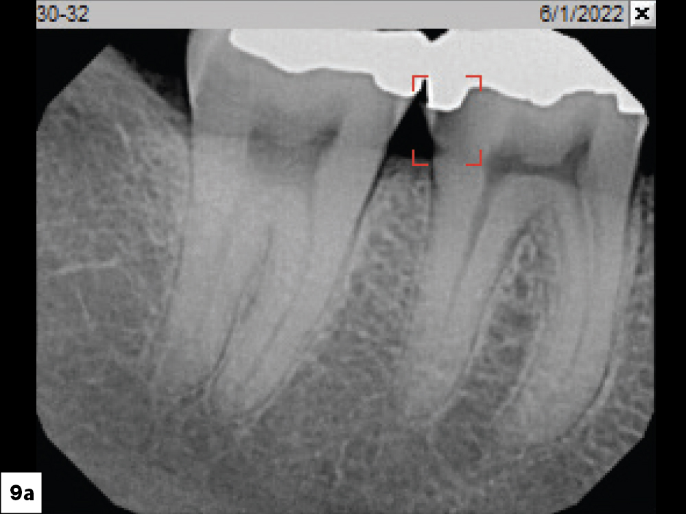 Figure 9a: X-ray of patient with a failing amalgam restoration on tooth #30
