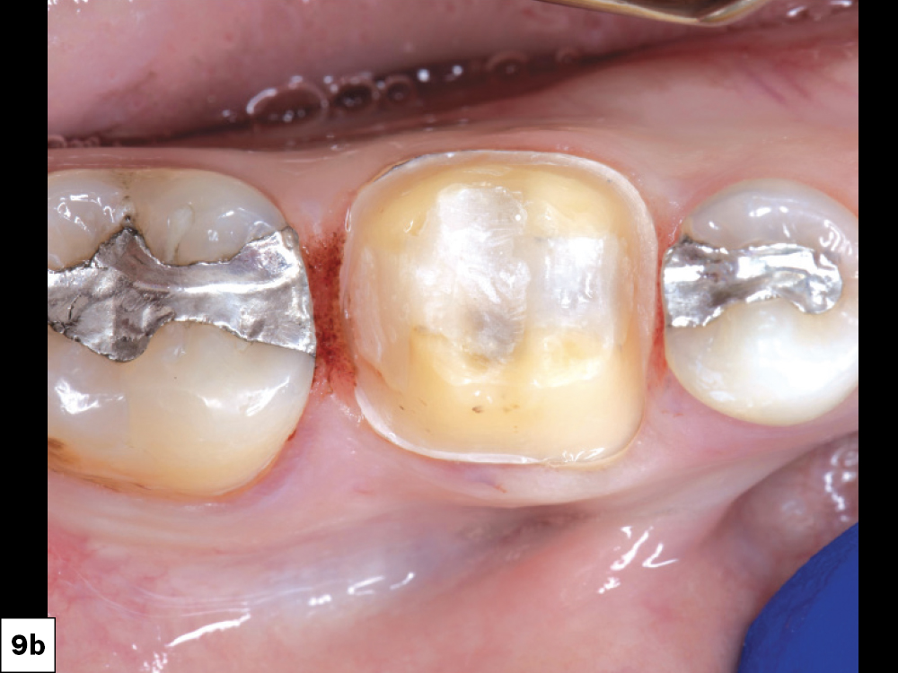 Figure 9b: Gingival inflammation on the distal where the caries progressed became more apparent 