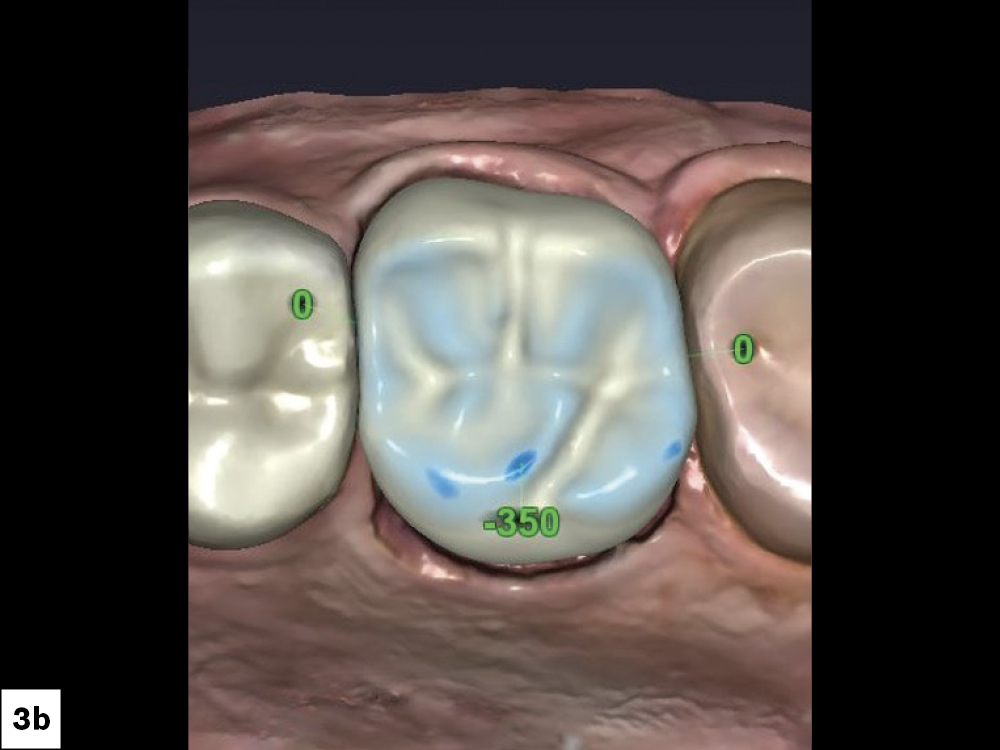 Figure 3b: Digital crown design adjusted for fabrication