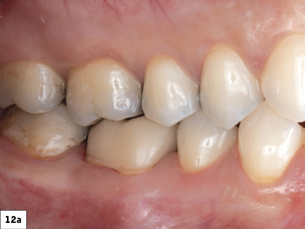 Figure 12a: End result of a functional, esthetic provisional