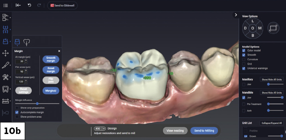 Figure 10b: Adjustments being made to the digital impression