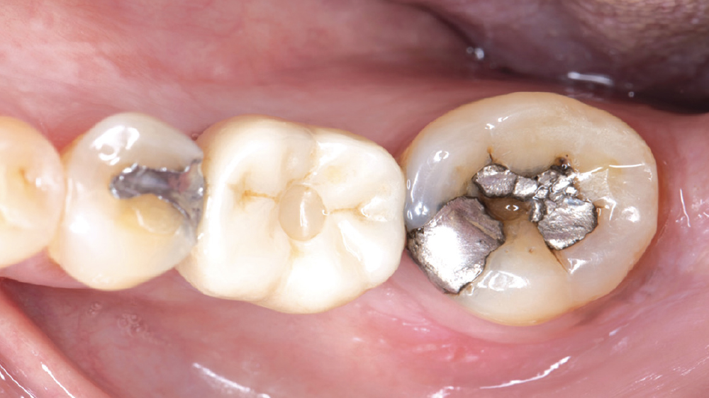 Figure 6: A patient with a fractured alloy restoration on tooth #18