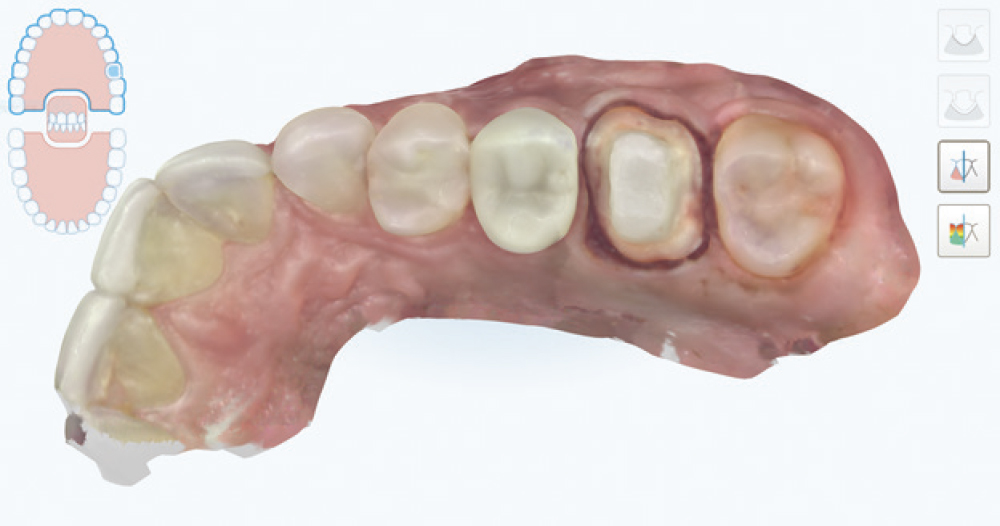 Figure 2: An intraoral scanned image of the affected tooth