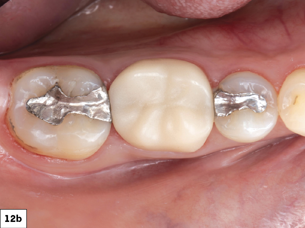 Figure 12b: Top view of end result of a functional, esthetic provisional