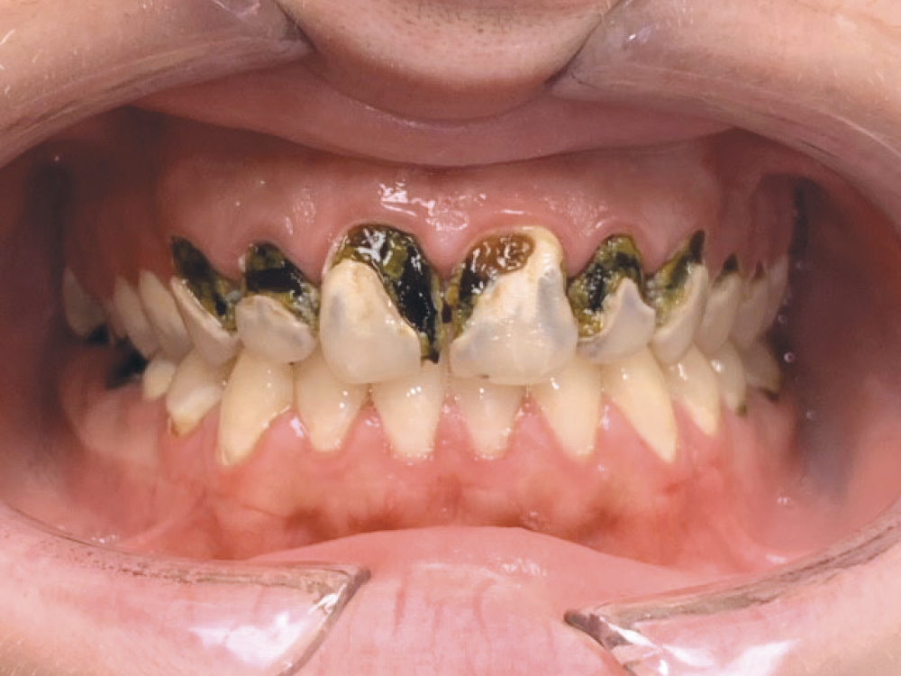 Patient mouth with extensive, disfiguring dental caries