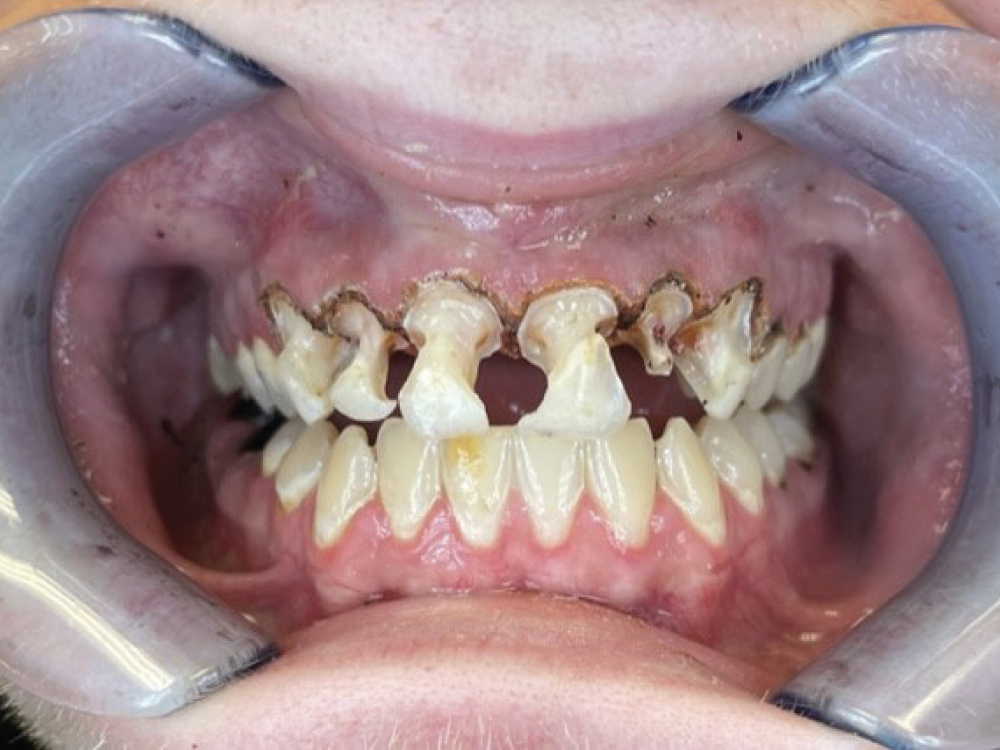 Tooth preparation image
