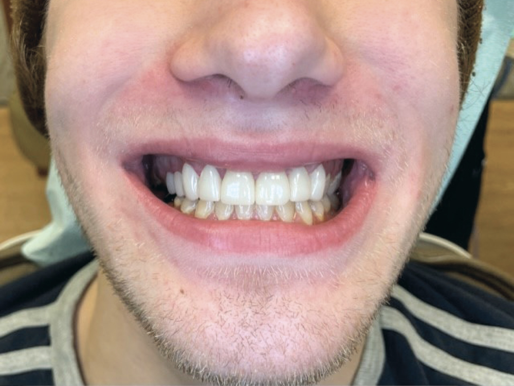 Patient smiling with BruxZir Esthetic NOW restorations