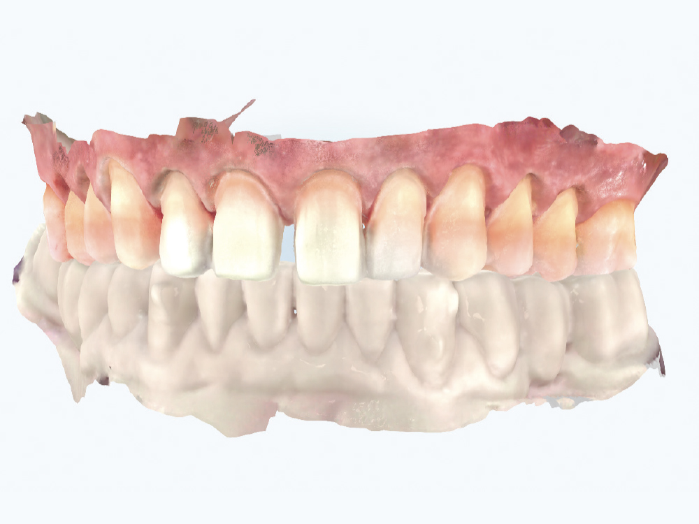 Digital scan of patient's teeth