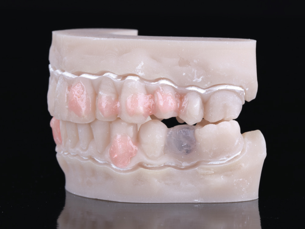 Before sample of patient's teeth