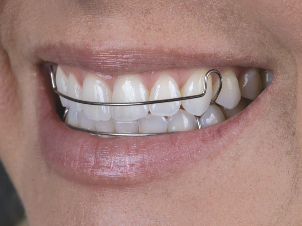 Close-up of patient wearing Hawley retainers
