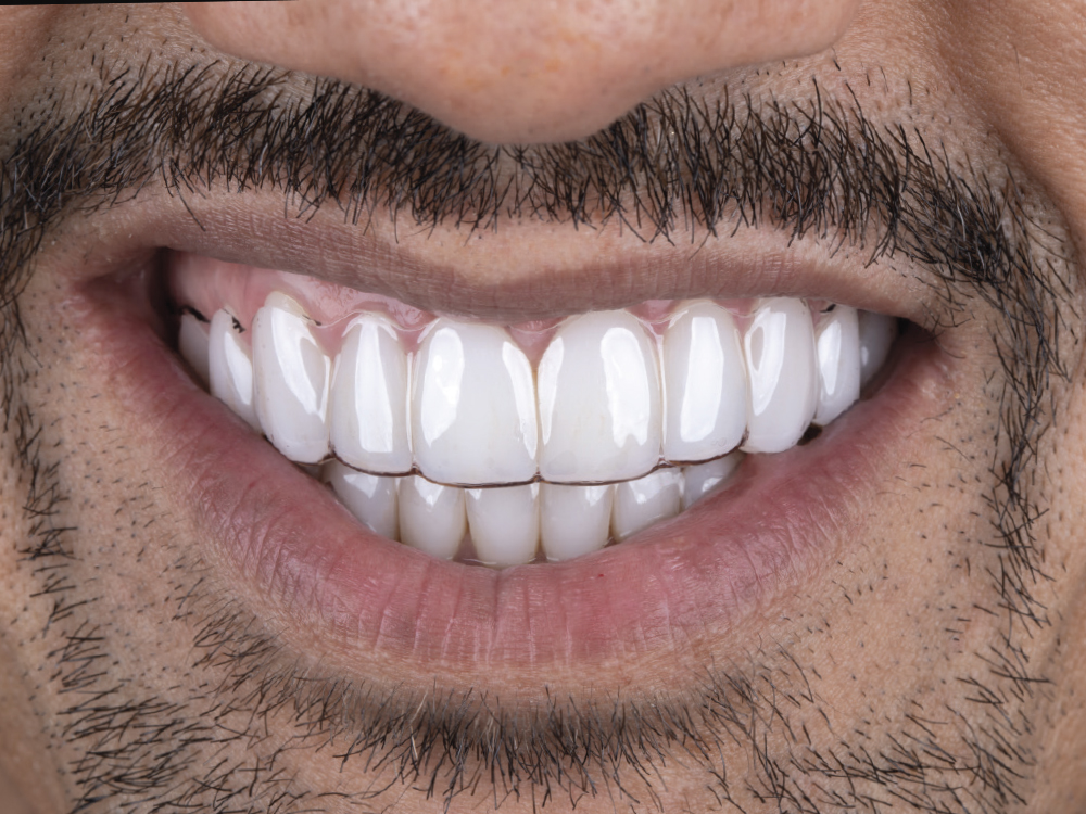 Close-up of patient's frontal teeth
