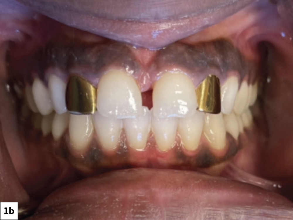 Figure 1b gold crowns on teeth #7 and #10 and diastema between #8 and #9