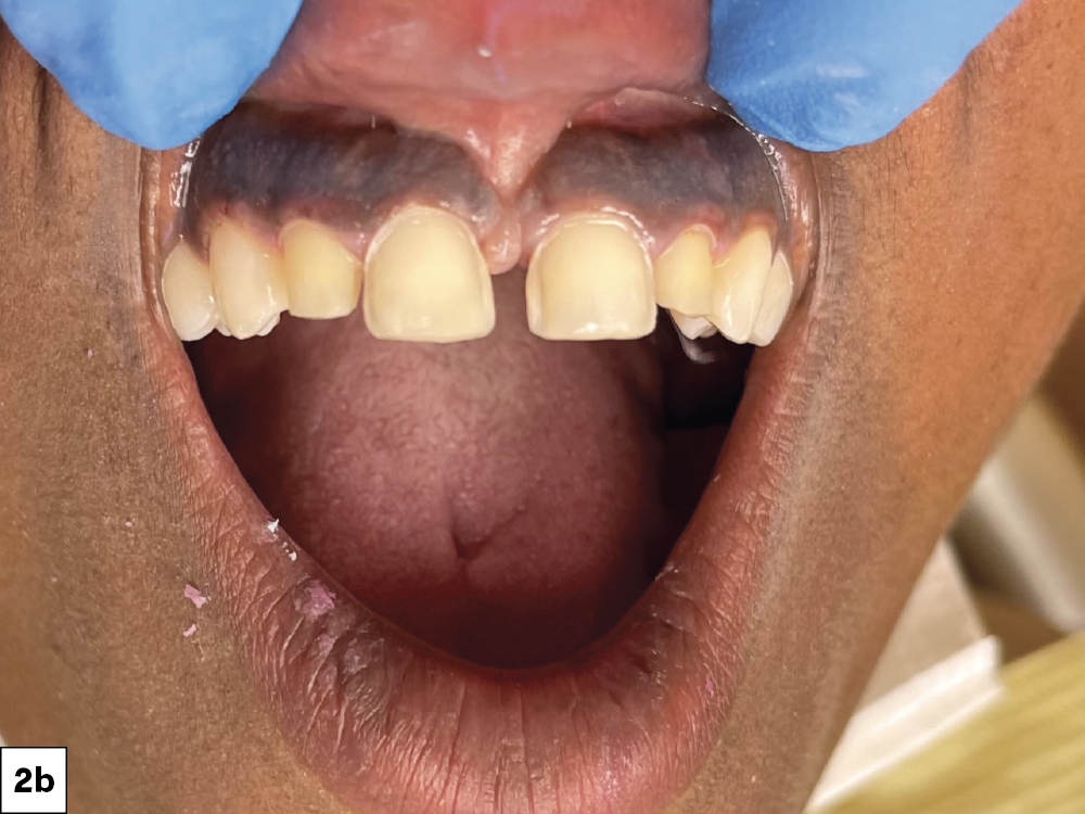 Figure 2b open mouth of teeth