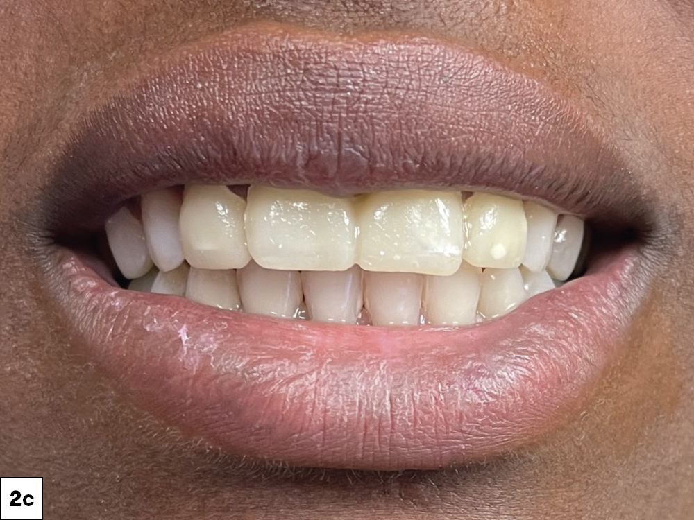 Figure 2c bulky teeth
