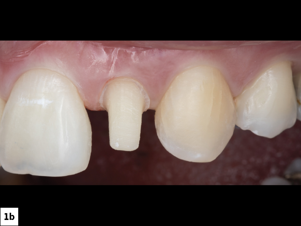 Figure 1b â  baby toothâ   appearance of tooth #10