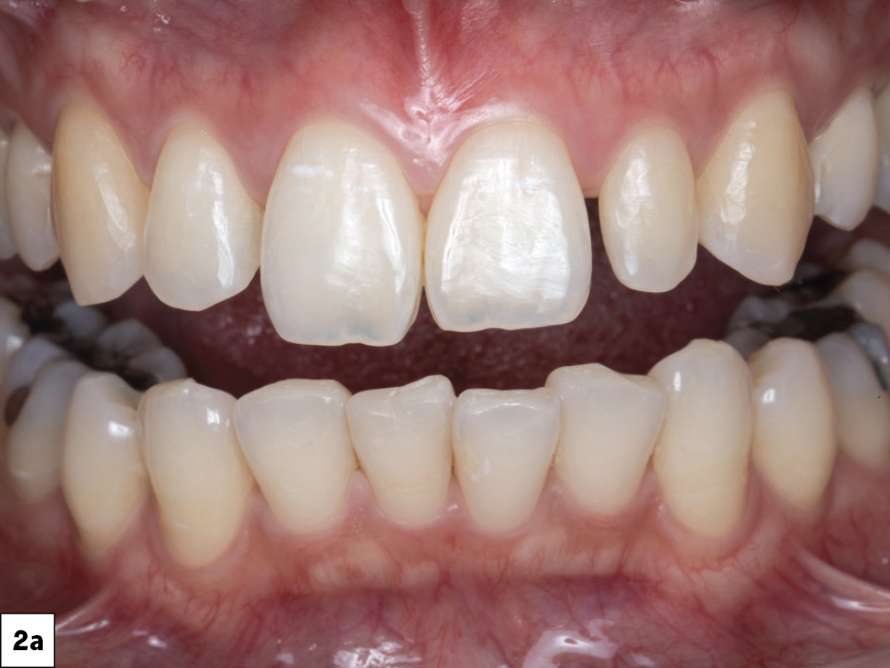Figure 2a gaps on teeth #7â  9