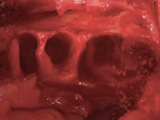 Socket Grafting: When to Graft and What to Use