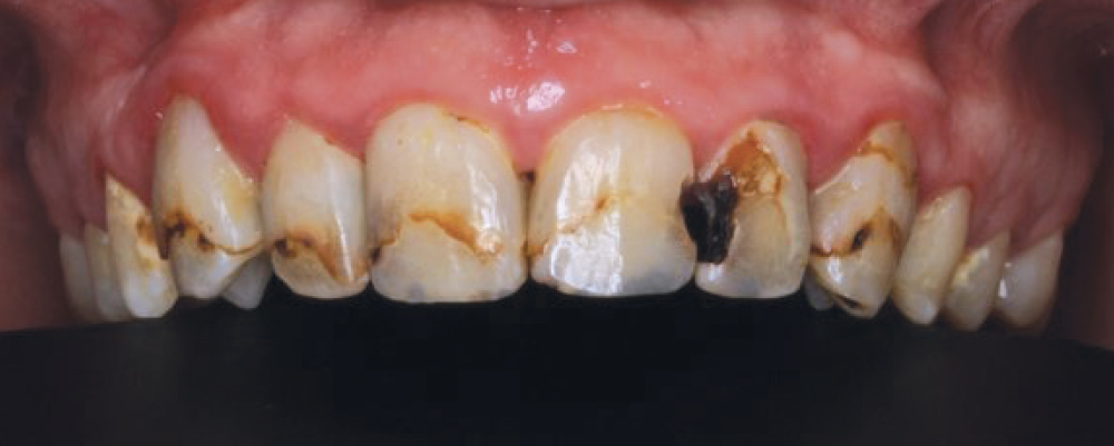 Figure 1 severe tooth decay