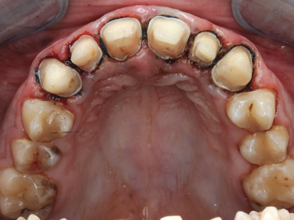 Figure 4 size #0 cord around the gingival margins