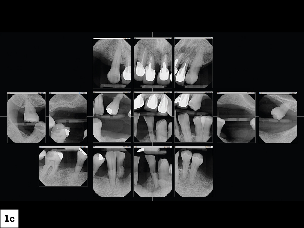 The patient before treatment oral x-ray