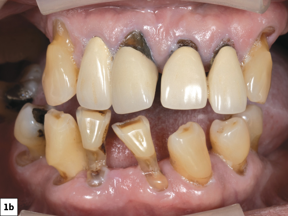 The patient before treatment oral picture