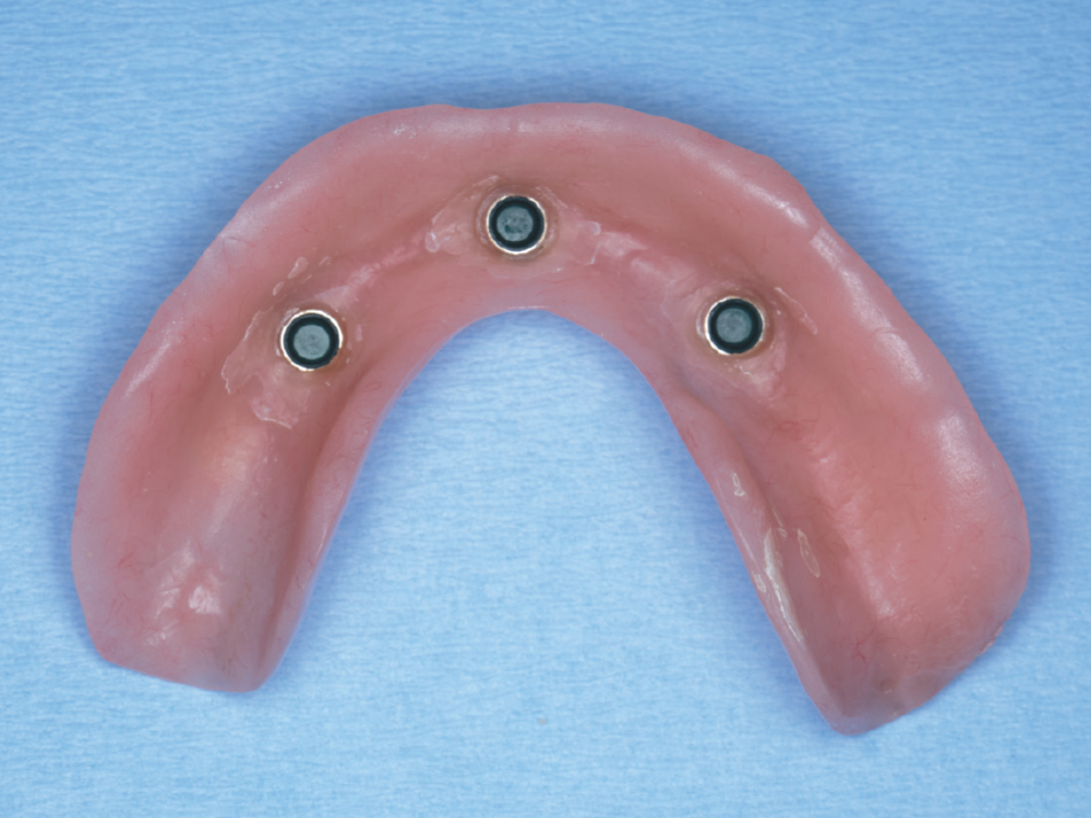 Extended-range, regular retention inserts were used as easier for the patient to keep clean.
