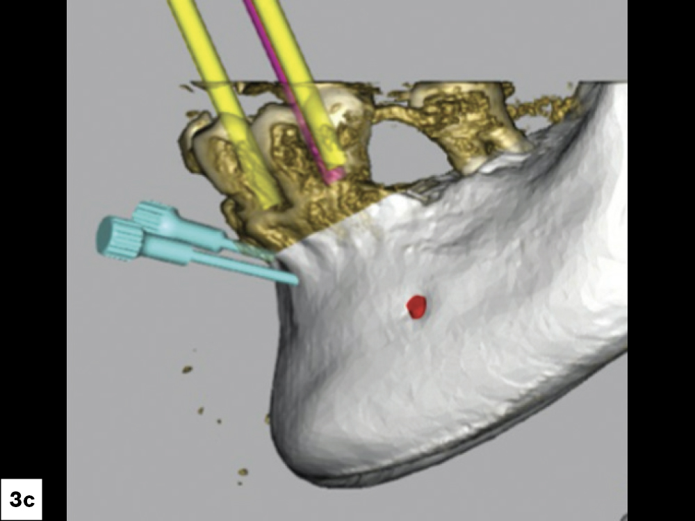Two implants in the canine positions with a third at the midline