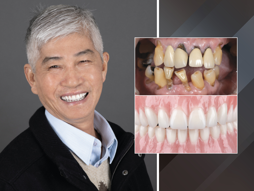 The Implant- Retained Mandibular Overdenture Hero Image