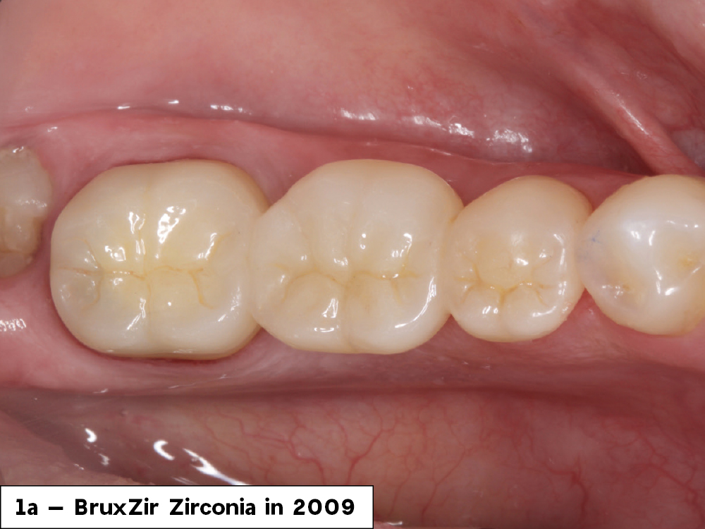 Figure 1a: BruxZir Zirconia in 2009