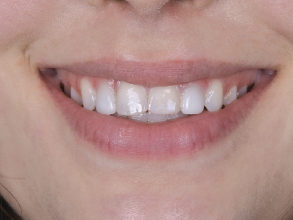 Figure 1 - close-up of patient's teeth shade