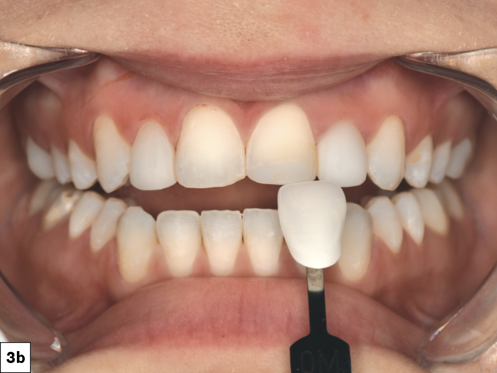 Figure 3b - Filtered lens is used to better match color of teeth