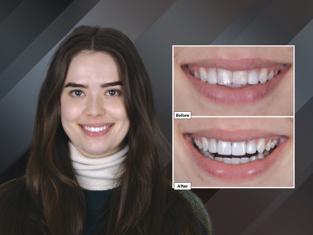 An Esthetic Solution with IPS e.max® Veneers