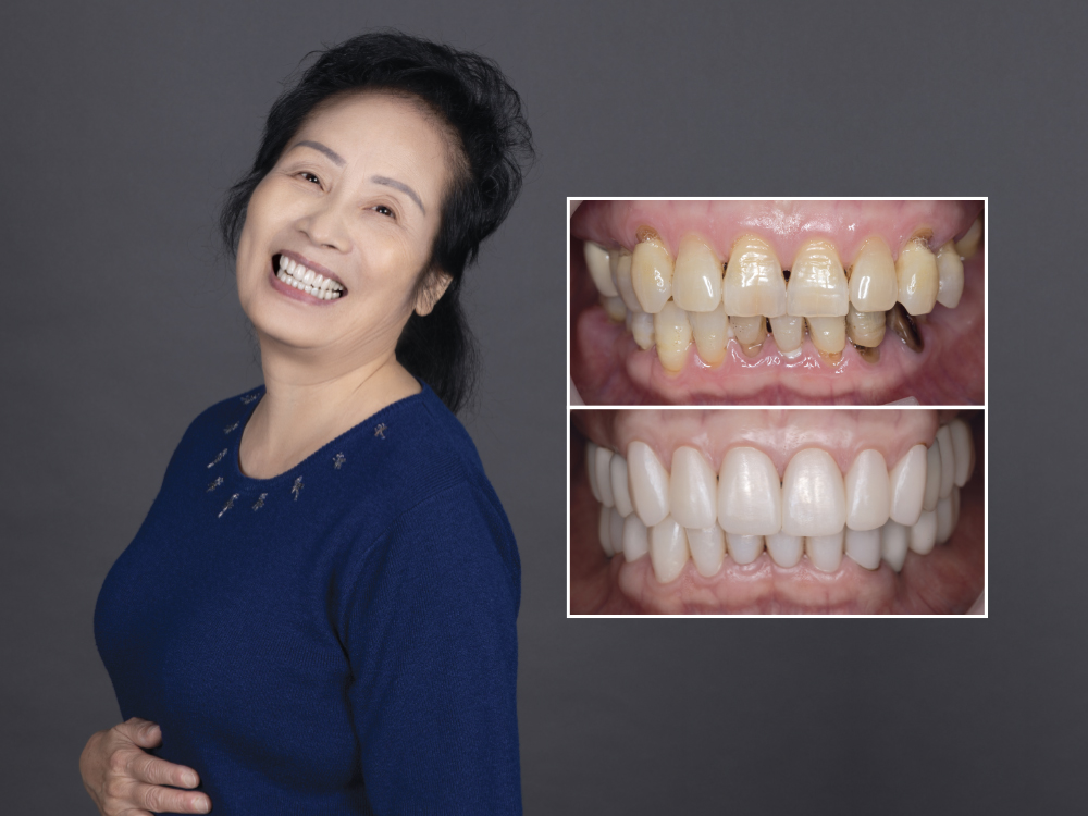 Laboratory  and Chairside  Partnership for  a Full-Mouth  Restoration