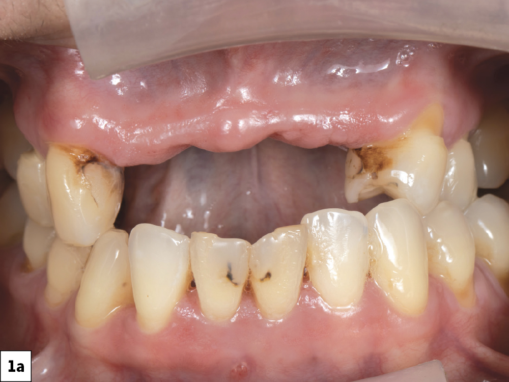 Figure 1a - patient's missing anterior teeth that was removed at a young age