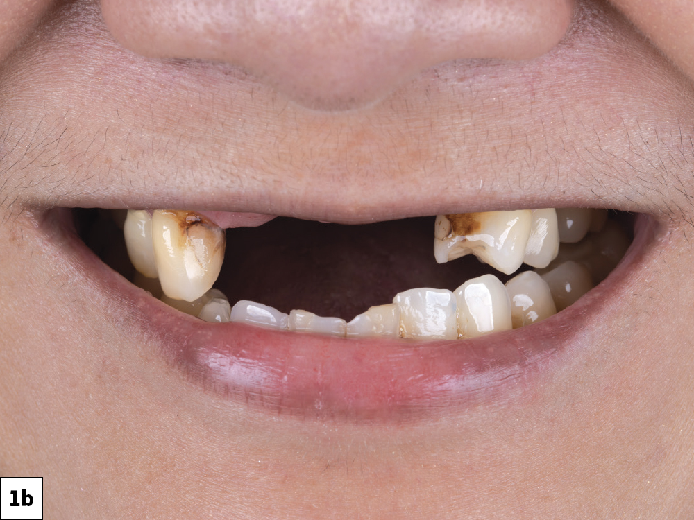 Figure 1b - patient's teeth