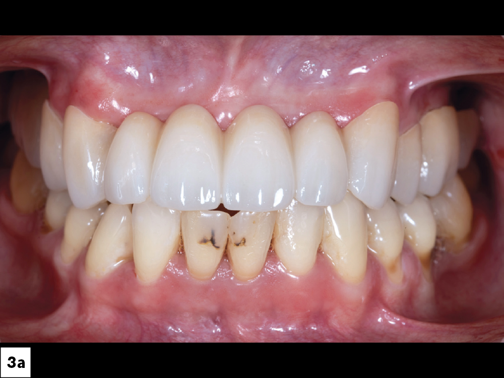 Figure 3a - Smile Transitions appliance was slipped over the untreated dentition (inside look)