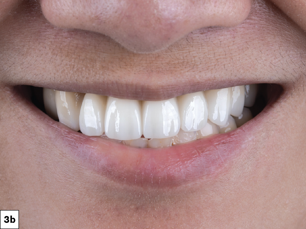 Figure 3b - Smile Transitions appliance was slipped over the untreated dentition (outside look)