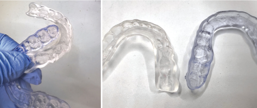 A comparison of two 3D-printed nightguard devices.