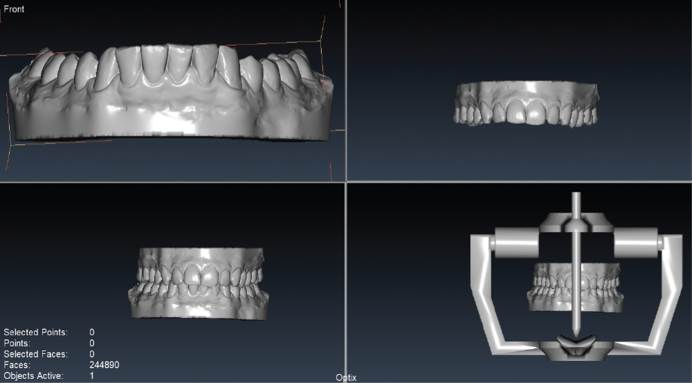Digital scans of appliances created using intraoral scanners.