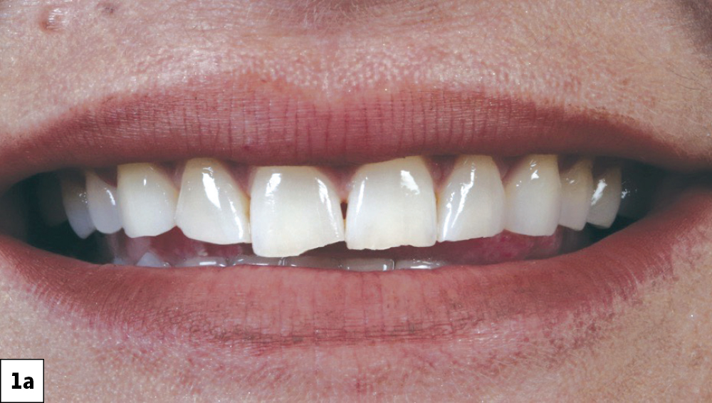 Figure 1a: 41-year-old female presented with worn c maxillary anterior teeth