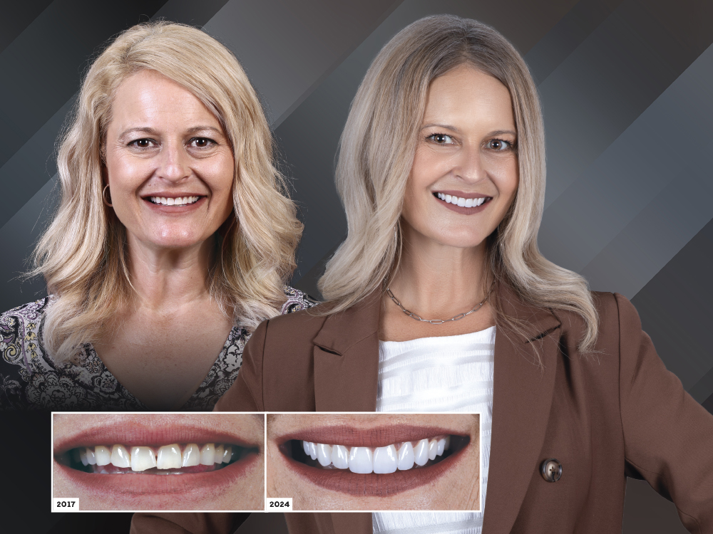 Esthetic Veneers: Lessons from a Seven-Year Recall