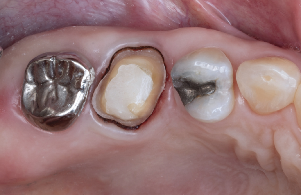 A set of teeth that needs to be entered in the intraoral scanner's data