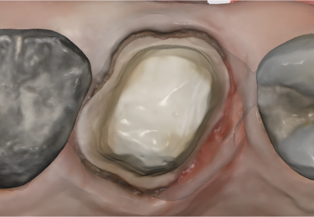 A view of soft tissue on teeth
