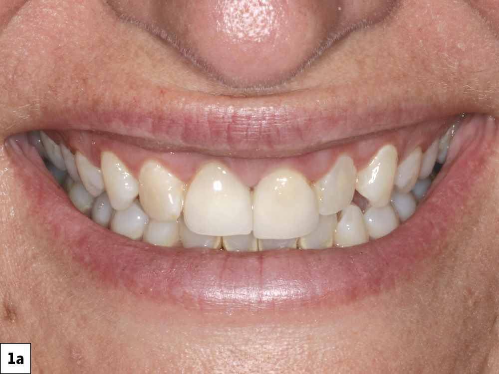 Figure 1a: patient front teeth