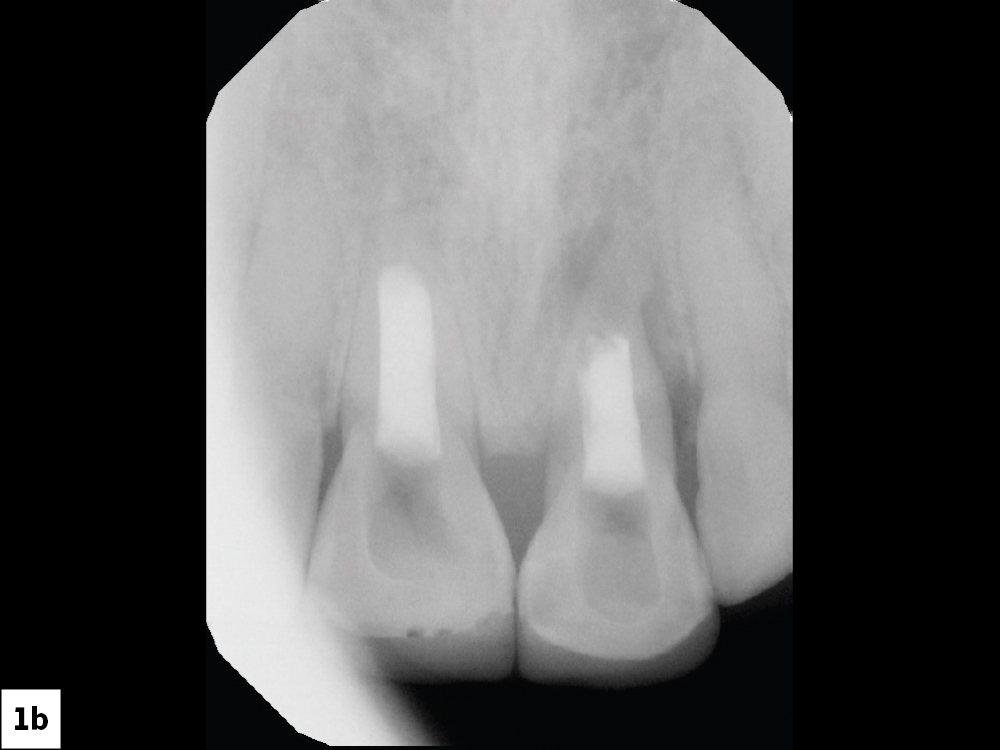 Figure 1b: x-ray of mobile maxillary central incisors