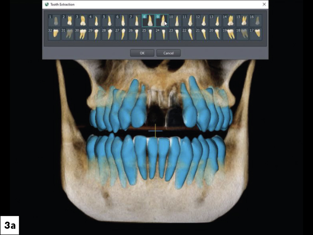 Figure 3a: visual of patient's facial plate