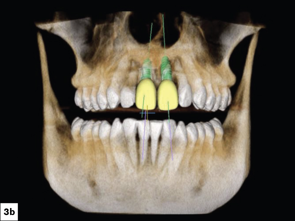 Figure 3b: crown-down approach