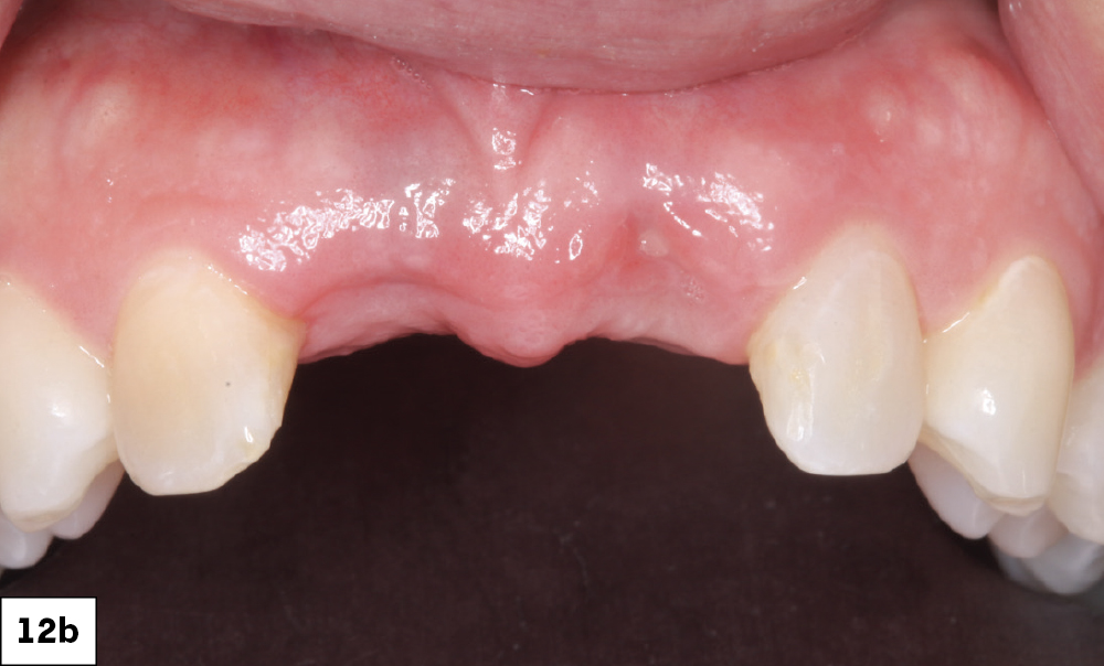 Figure 12b: healed after 7 days